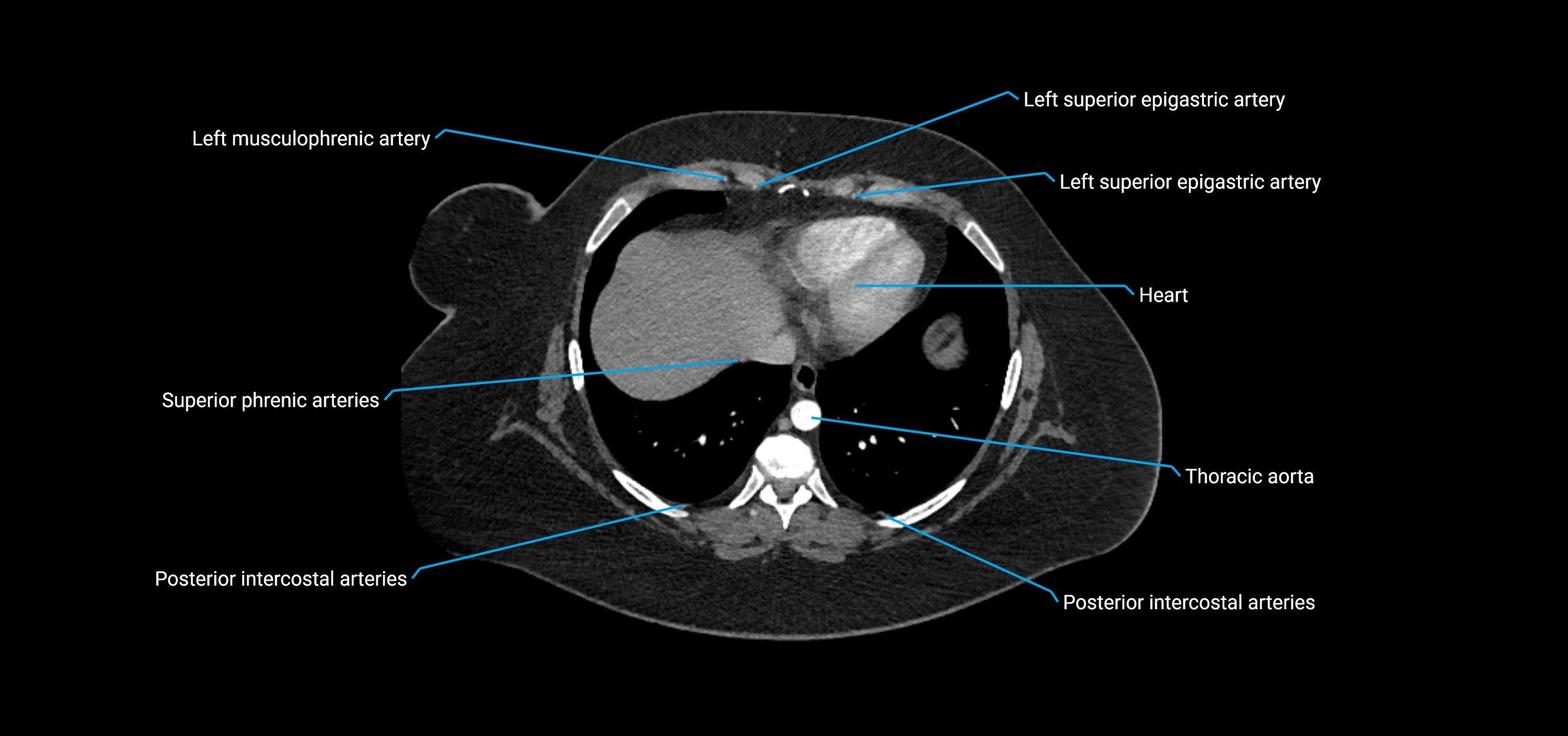 CTA abdomen axial cross sectional anatomy labelled image_12 (1).webp